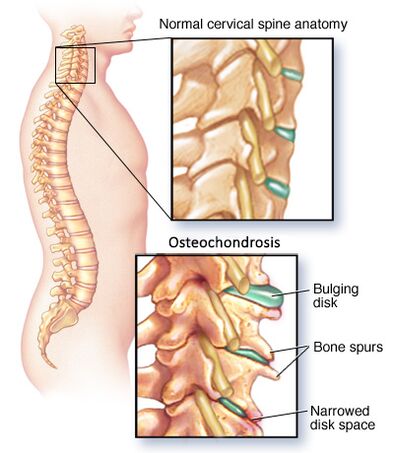 osteocondrose cervical