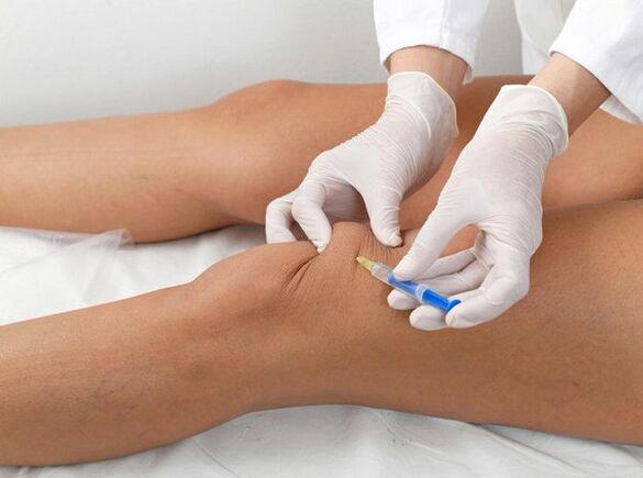 injeção intra-articular para artrose do joelho